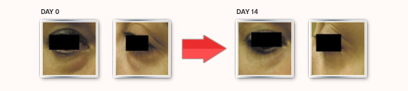 Eyeseryl shows noticeable results after 14 days