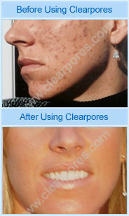 before and after using clearpores acne treatment