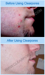 ClearPores convinced me, my skin is spot free now!